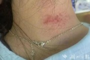 冬季出生八字特点:在线测算事业运势www.jixiangqiming.vip：-重金属超标！女子戴项链引发“首饰病”